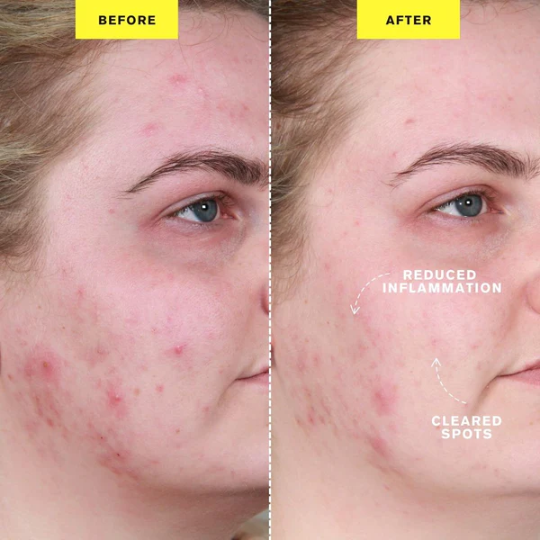 ZIIP-DOT-Results-Reduced-Acne_600x
