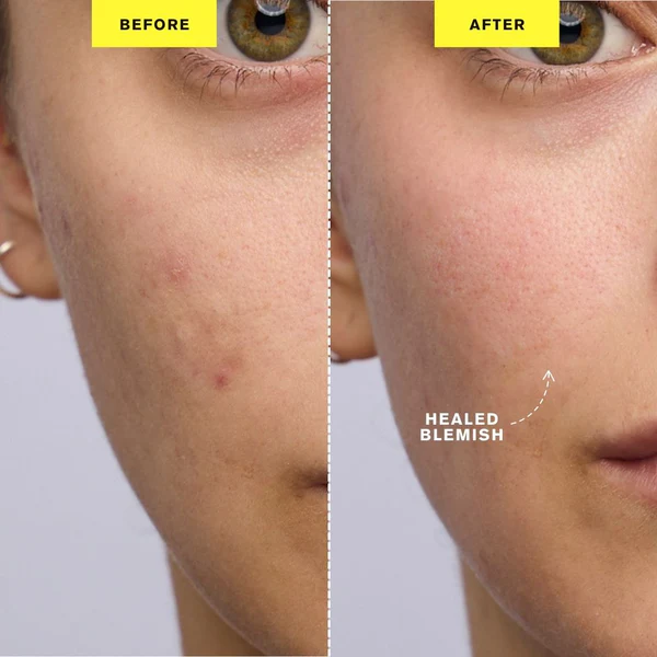 ZIIP-DOT-Results-Reduced-Blemishes_600x